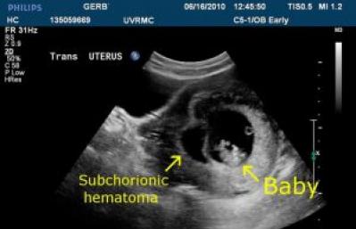 Гематома в матке (ретрохориальная гематома): чем опасна на ранних сроках беременности, способы лечения, шансы сохранить ребенка Гематома при беременности как долго будут выделения